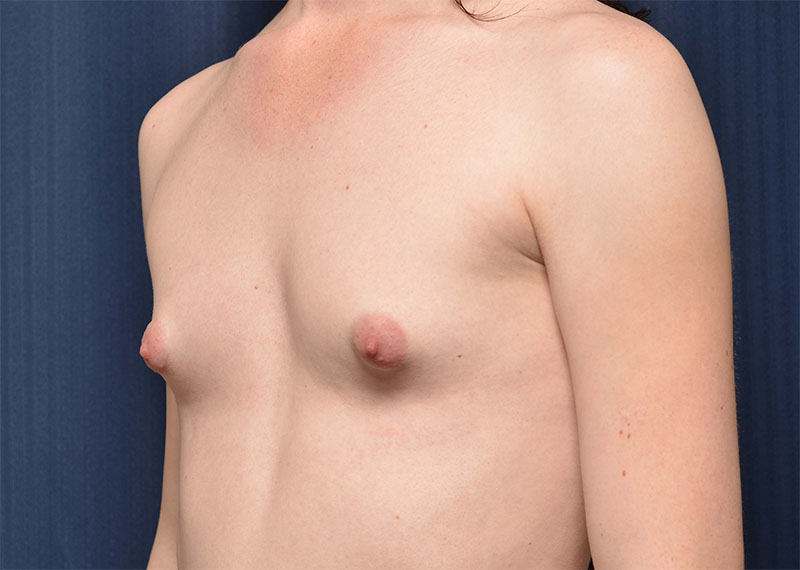 Transition Top Surgery