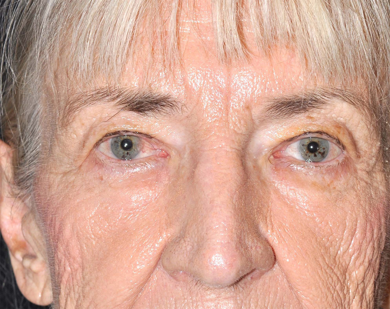 Eyelid Lift / Brow Lift