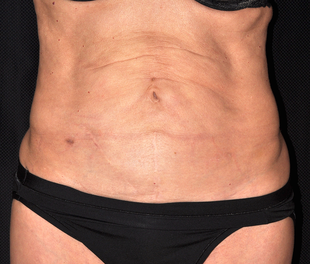 Tummy Tuck