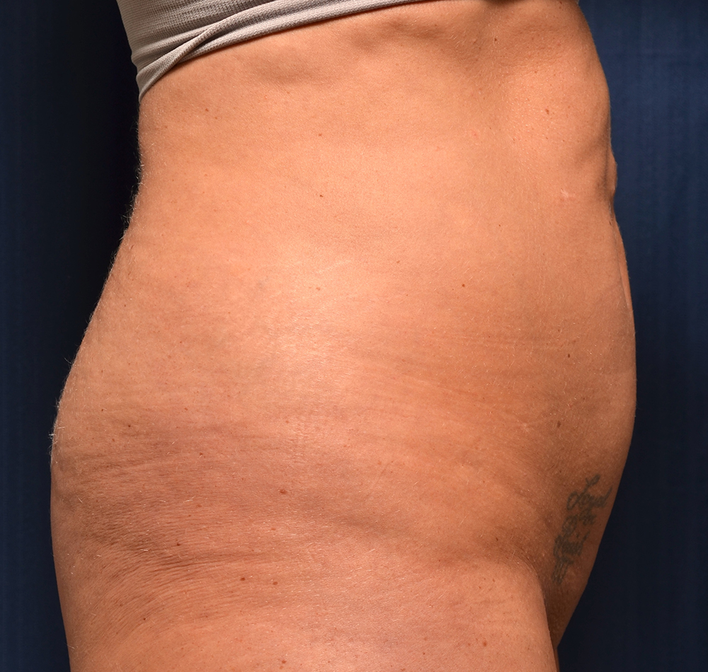 Tummy Tuck