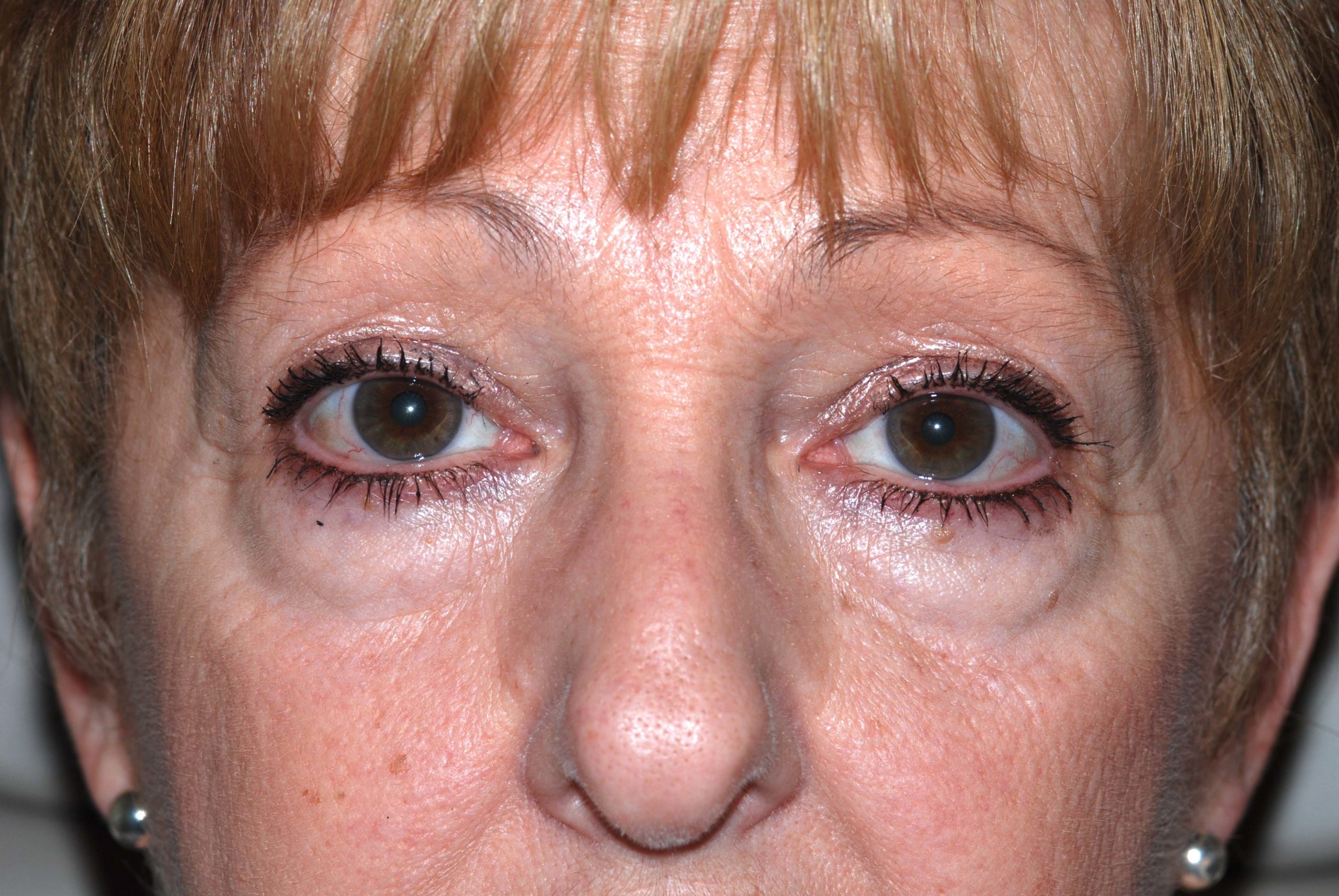 Eyelid Lift / Brow Lift