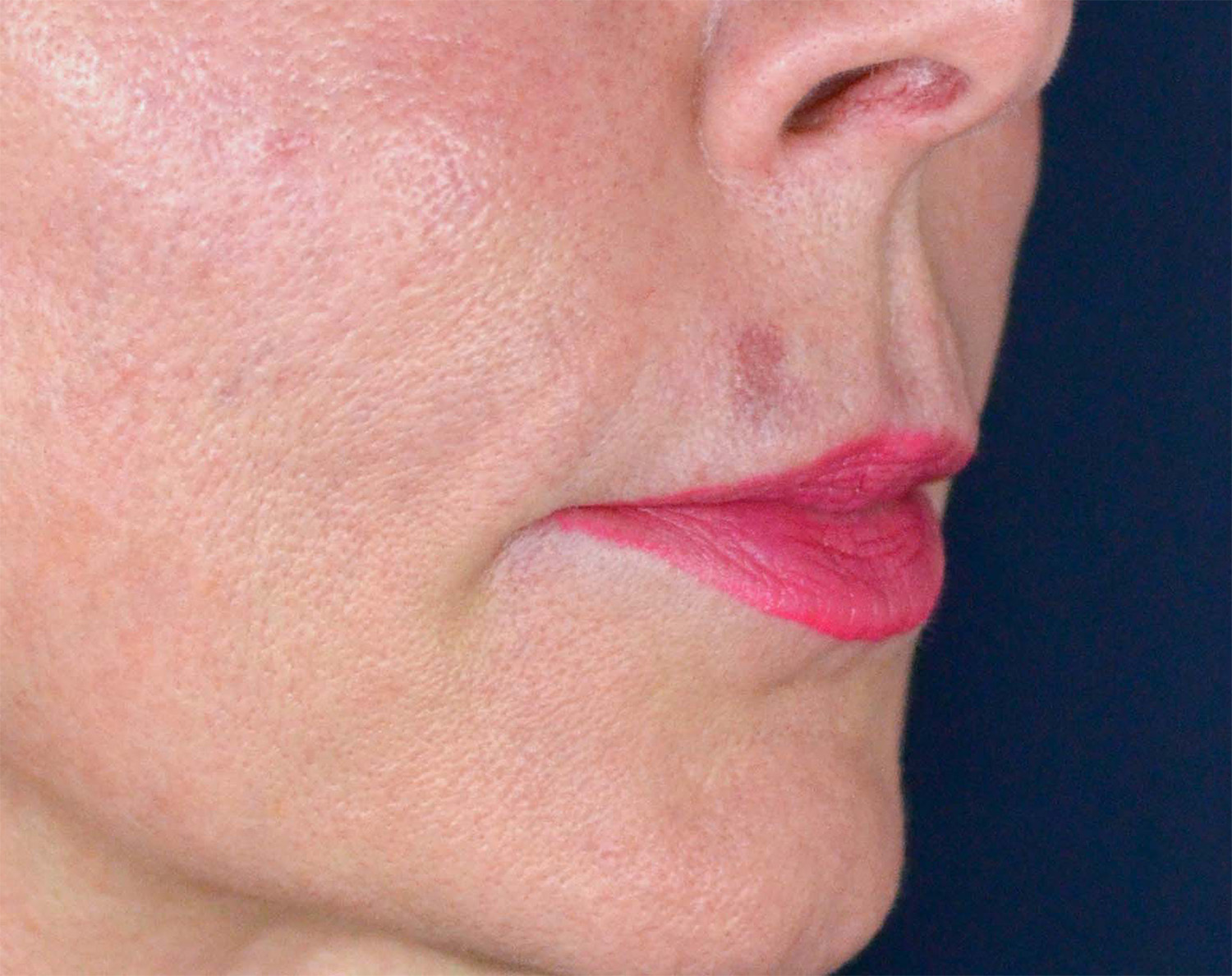 Lip Augmentation / Lip Lift