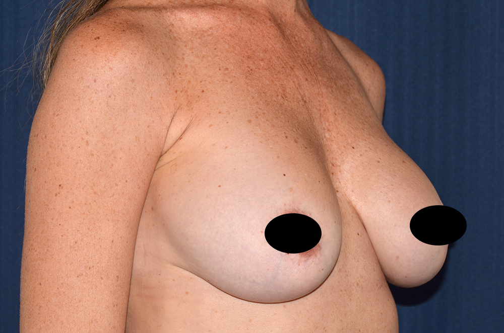 Breast Implant Revision