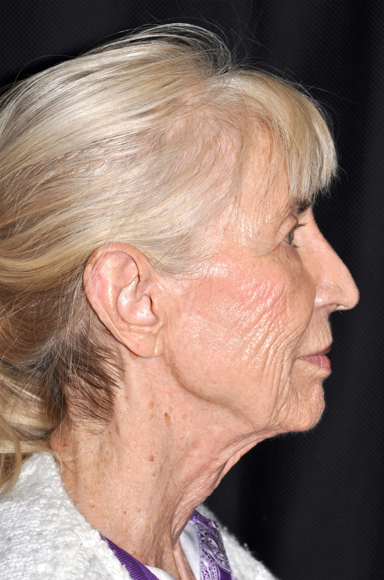 Facelift / Neck Lift