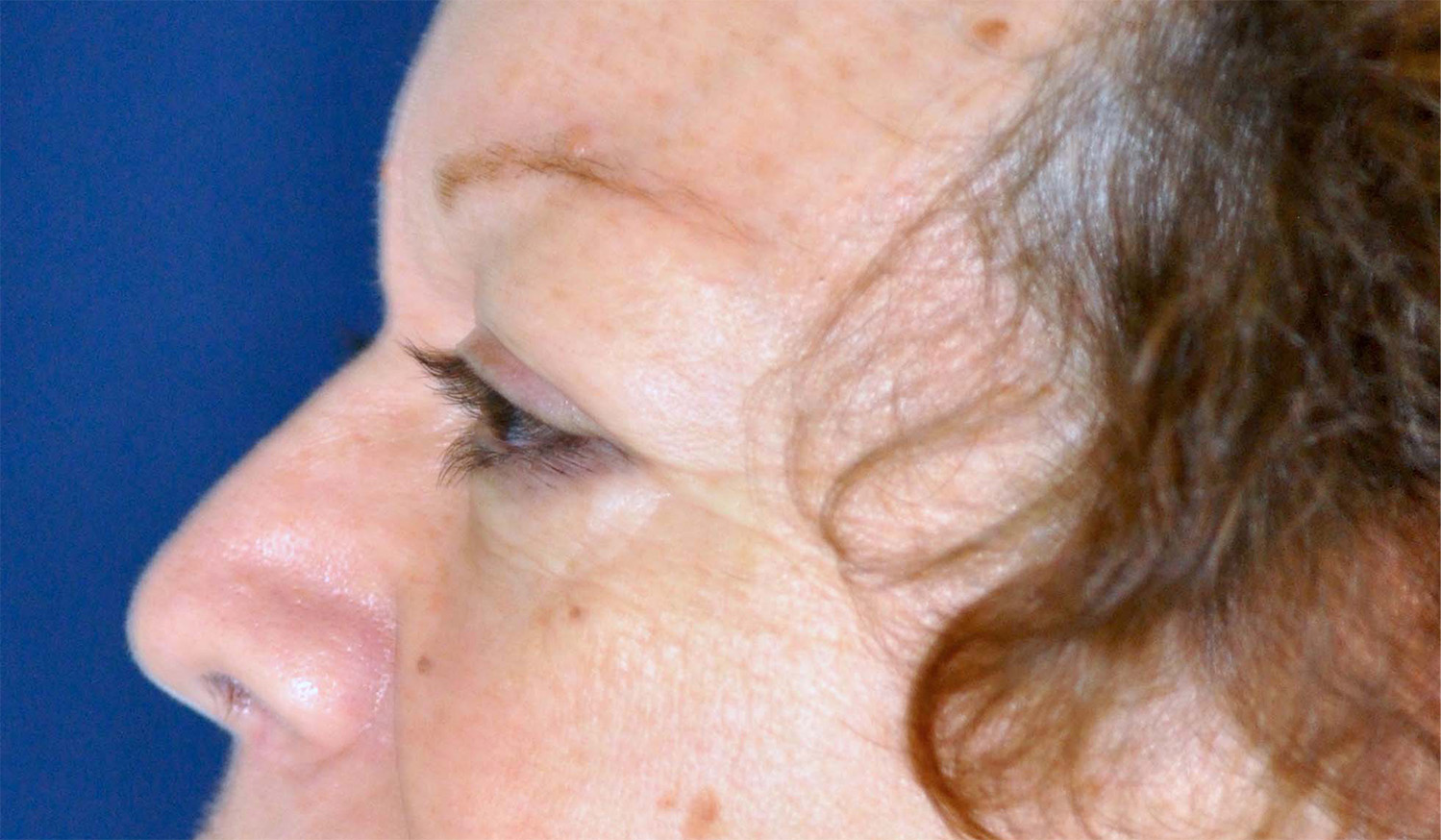 Eyelid Lift / Brow Lift