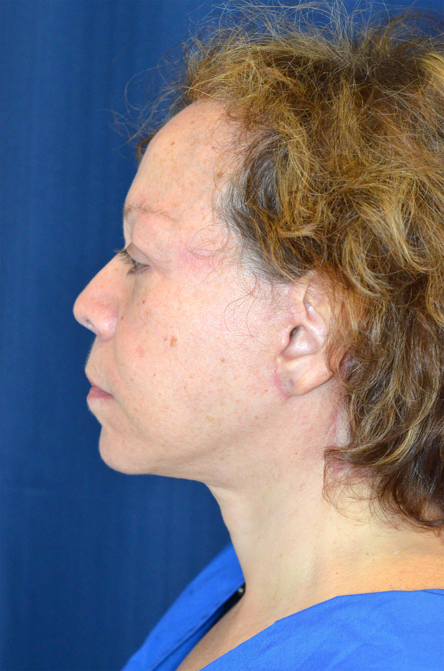 Facelift / Neck Lift