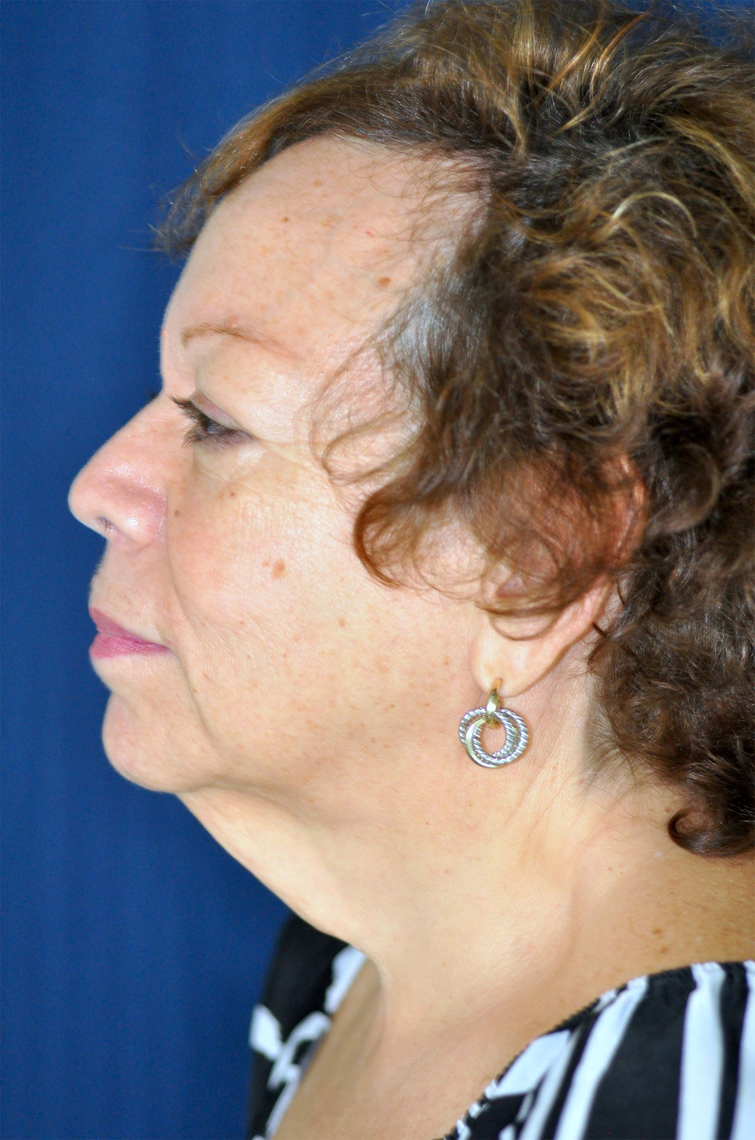 Facelift / Neck Lift