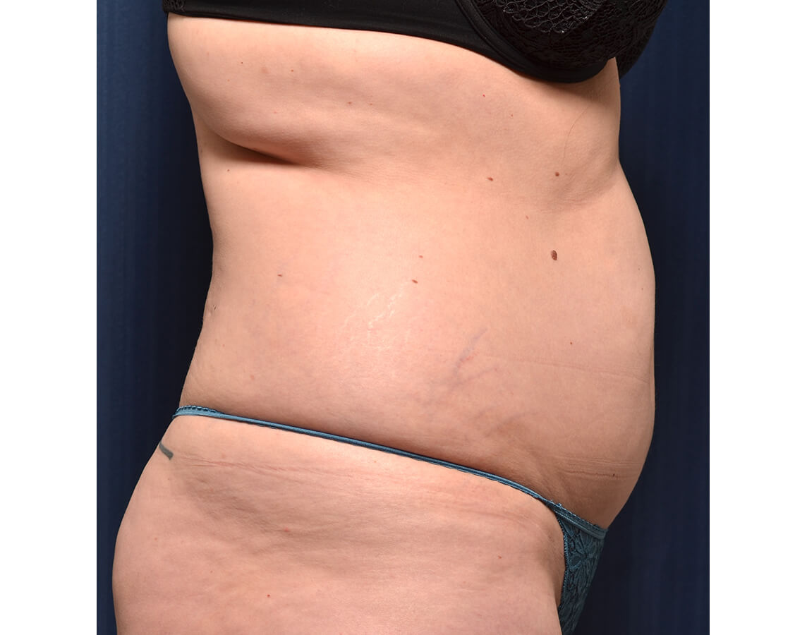 Liposuction