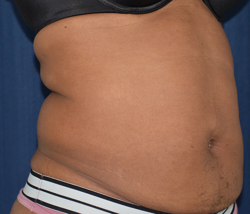 Tummy Tuck