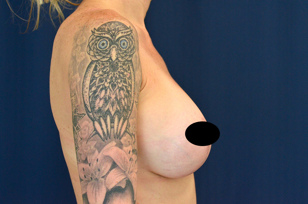 Breast Implant Revision