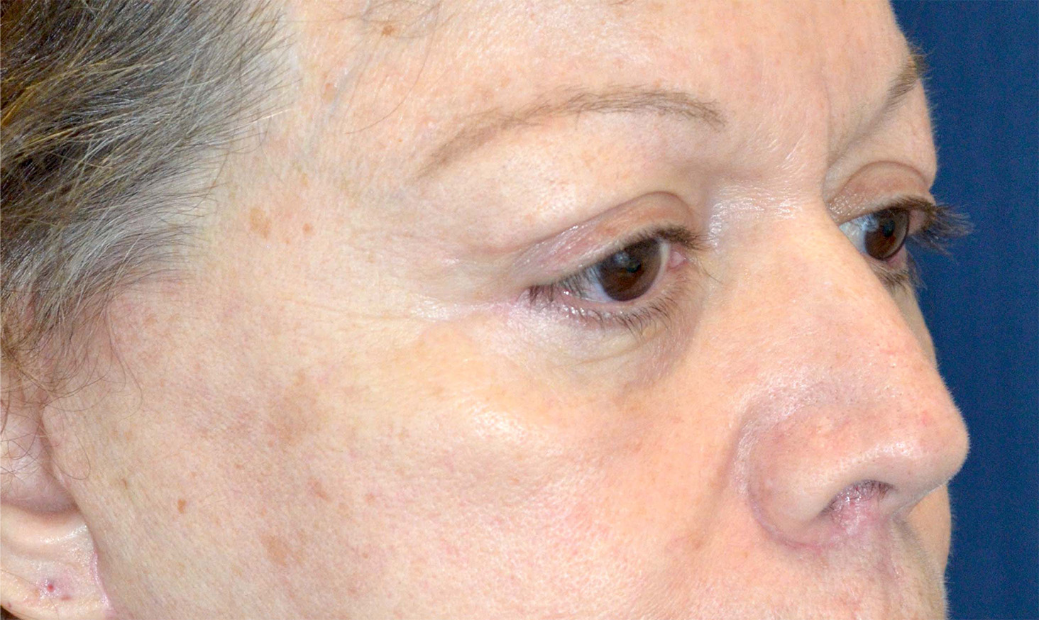 Eyelid Lift / Brow Lift