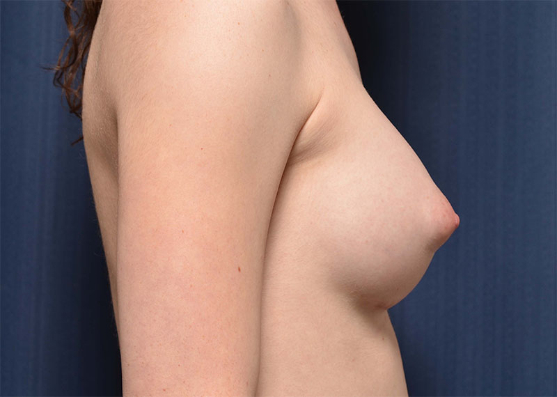 Transition Top Surgery