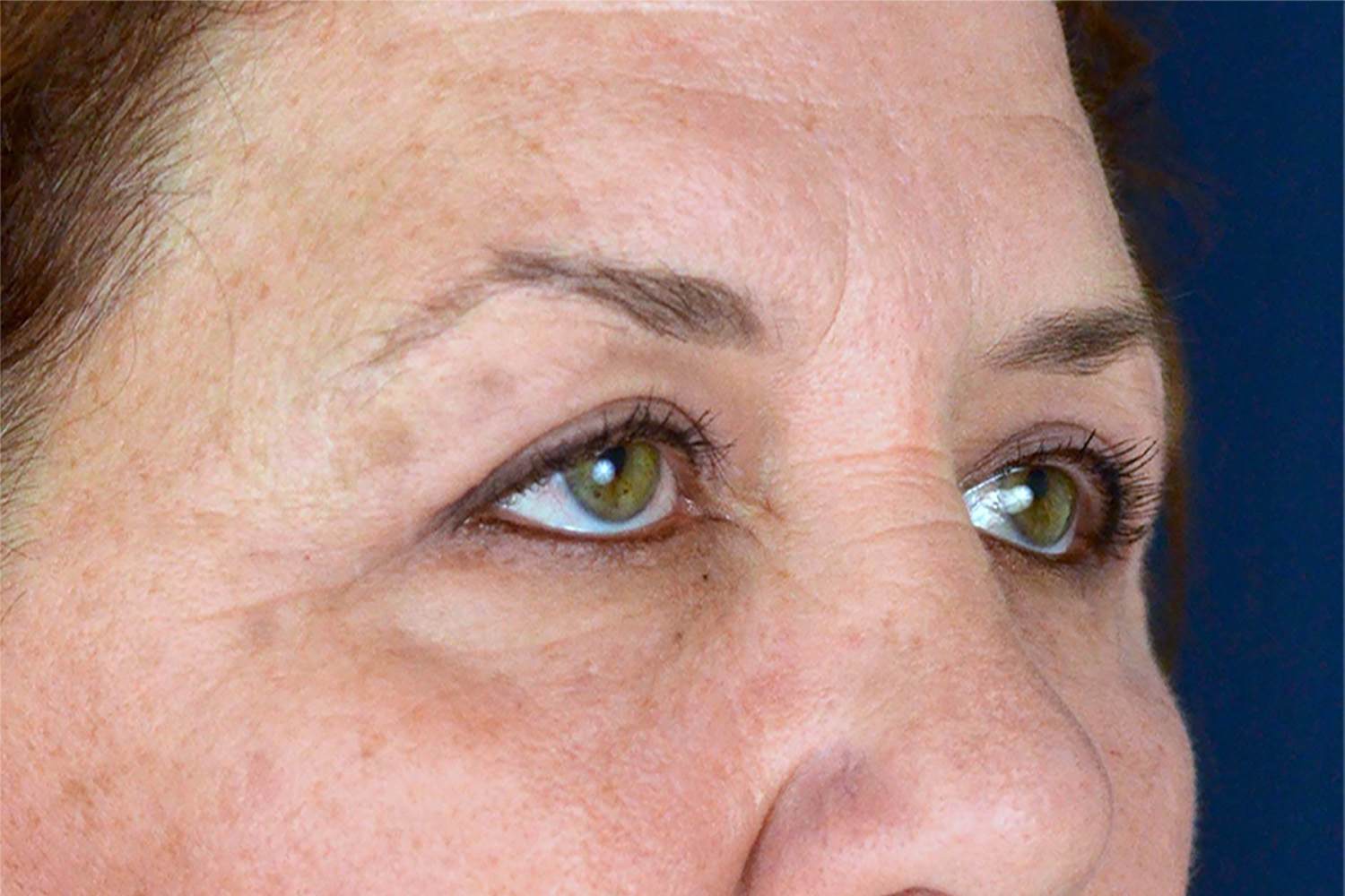 Eyelid Lift / Brow Lift