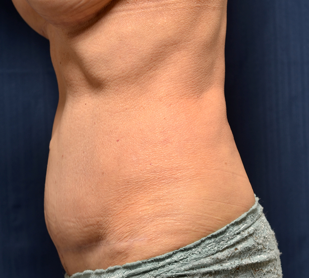 Tummy Tuck