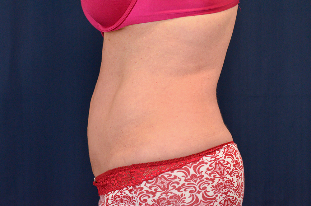 Tummy Tuck