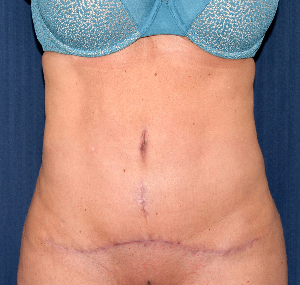 Tummy Tuck