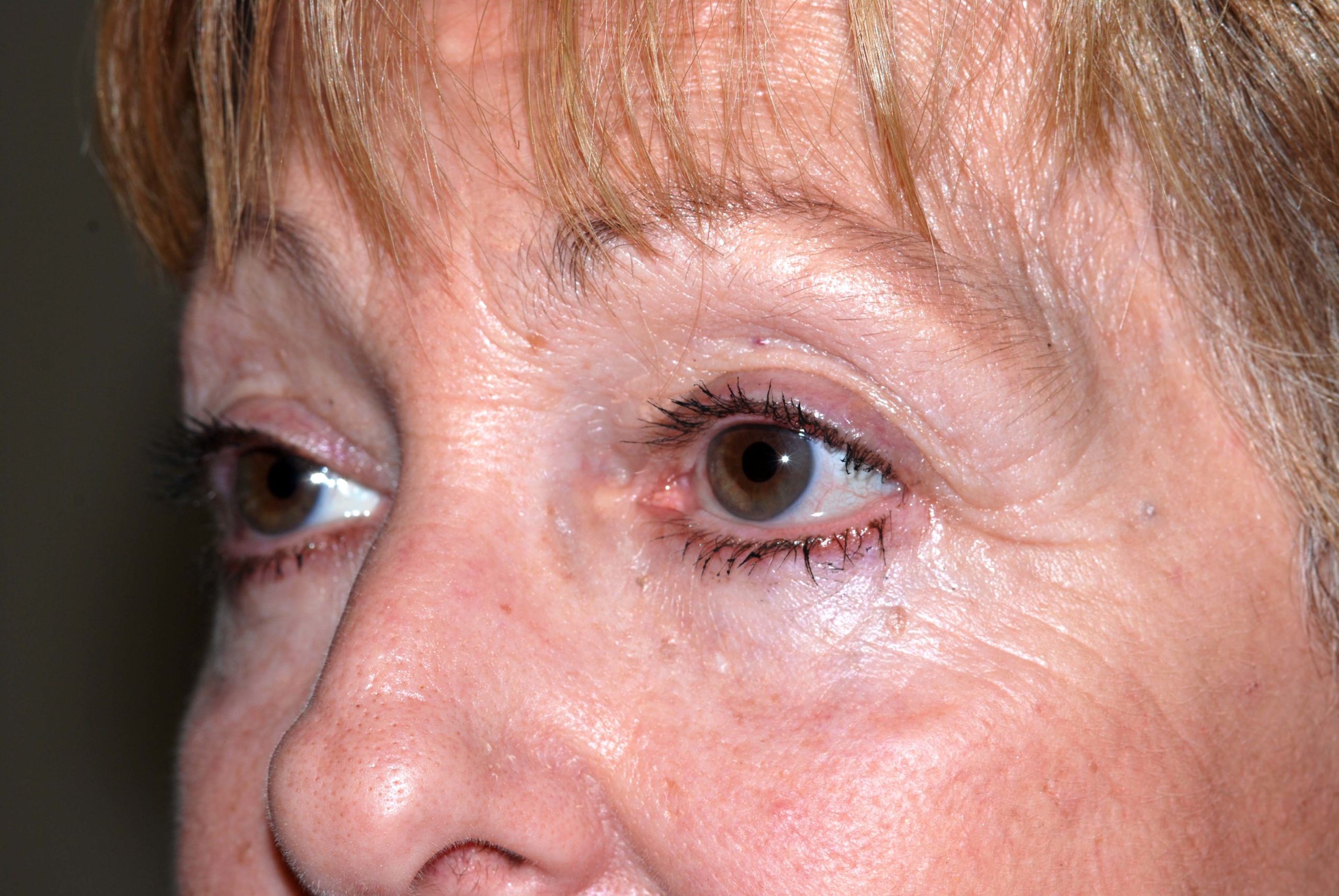 Eyelid Lift / Brow Lift