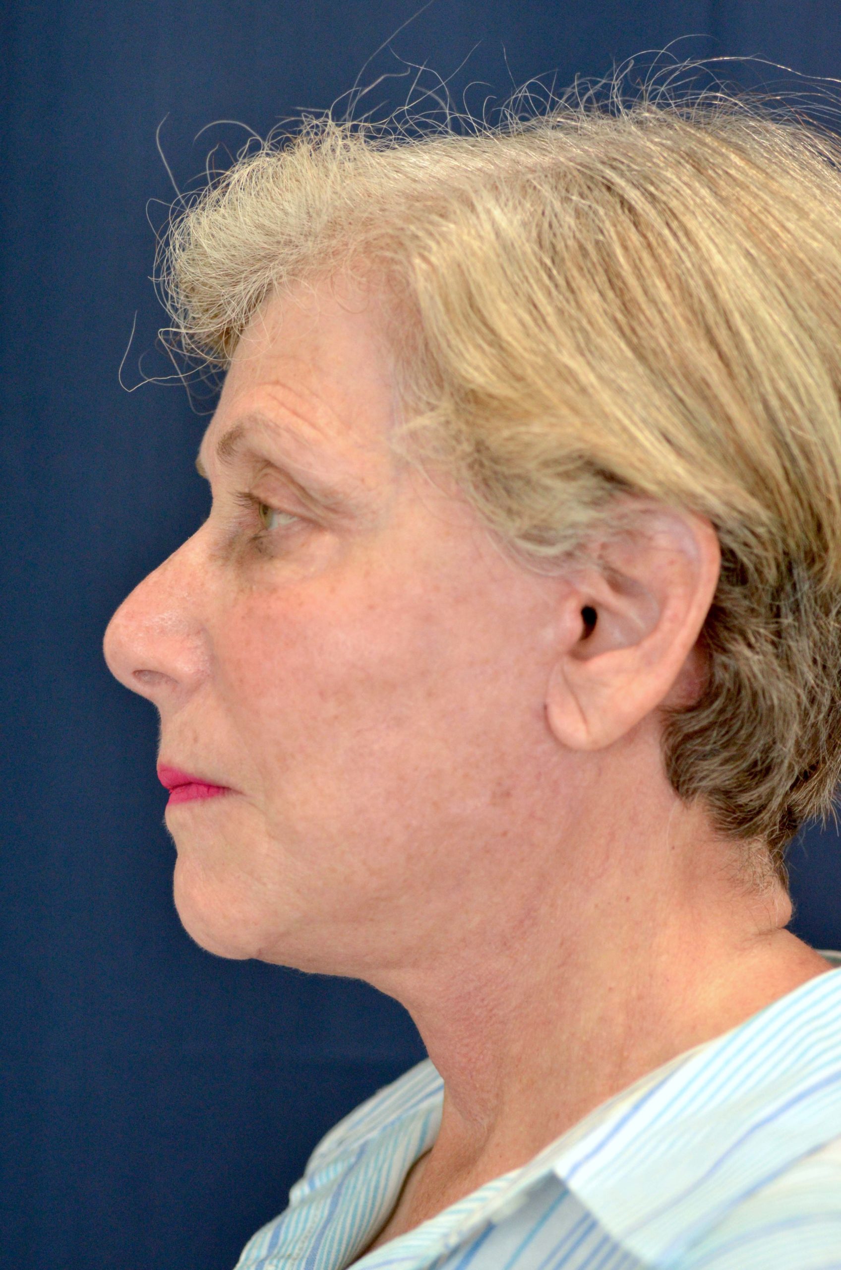 Facelift / Neck Lift