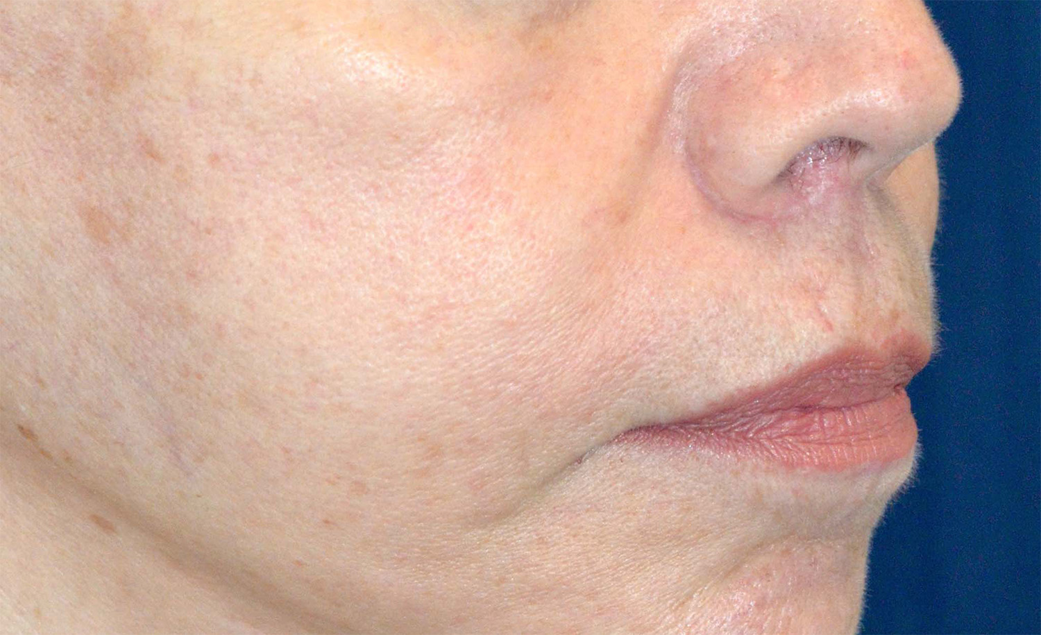 Lip Augmentation / Lip Lift