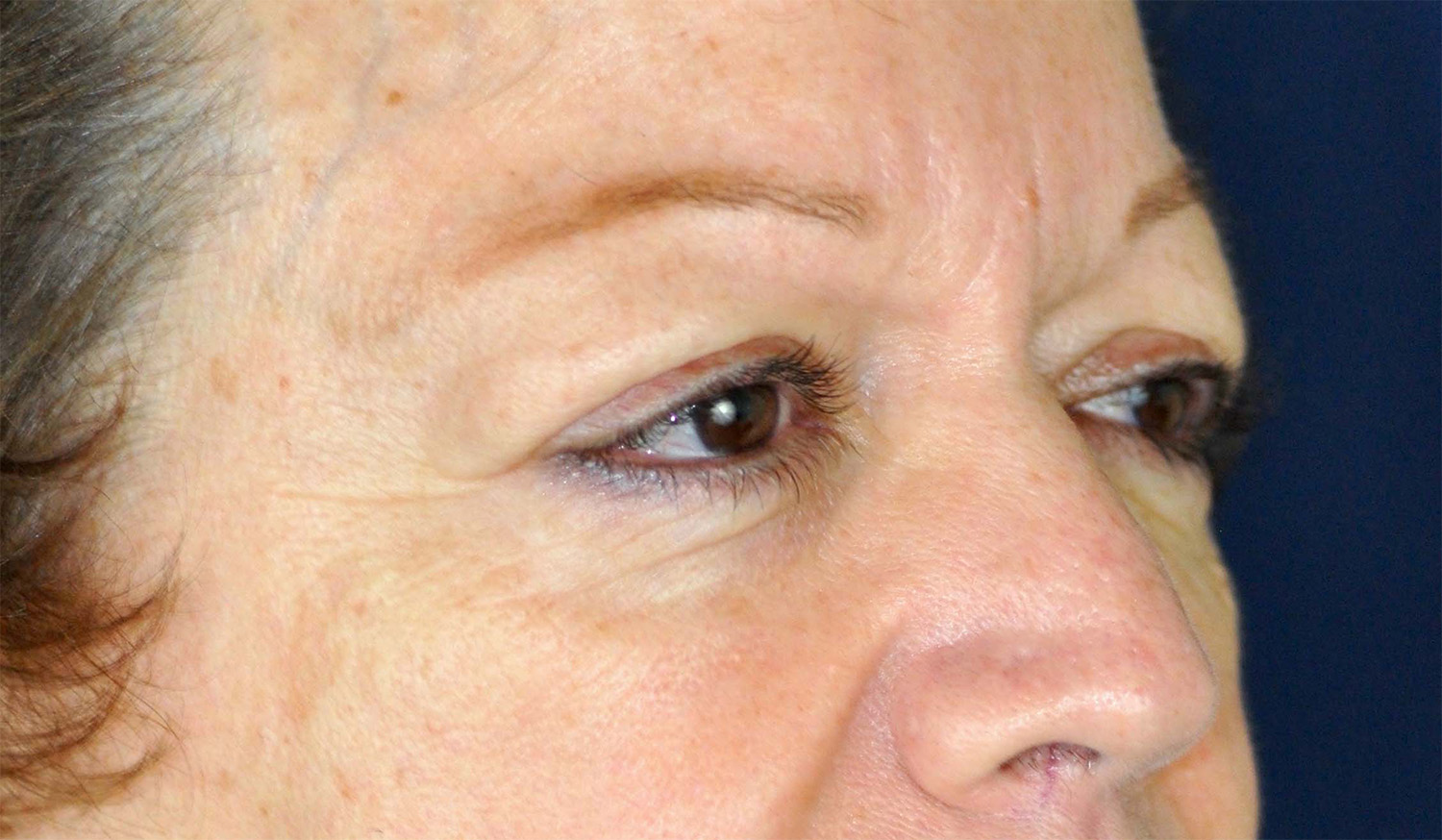 Eyelid Lift / Brow Lift