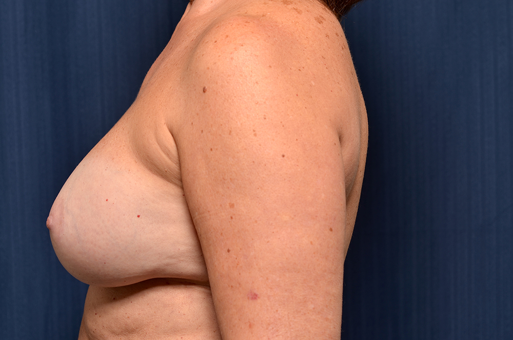 Breast Implant Revision