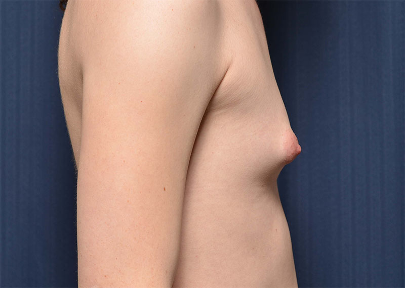 Transition Top Surgery