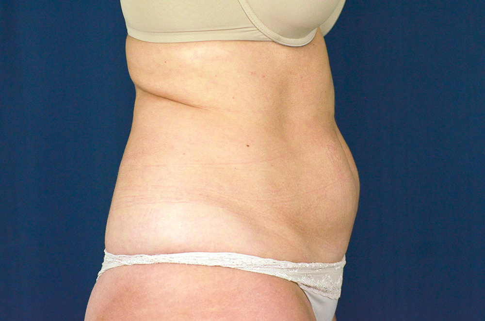 Liposuction