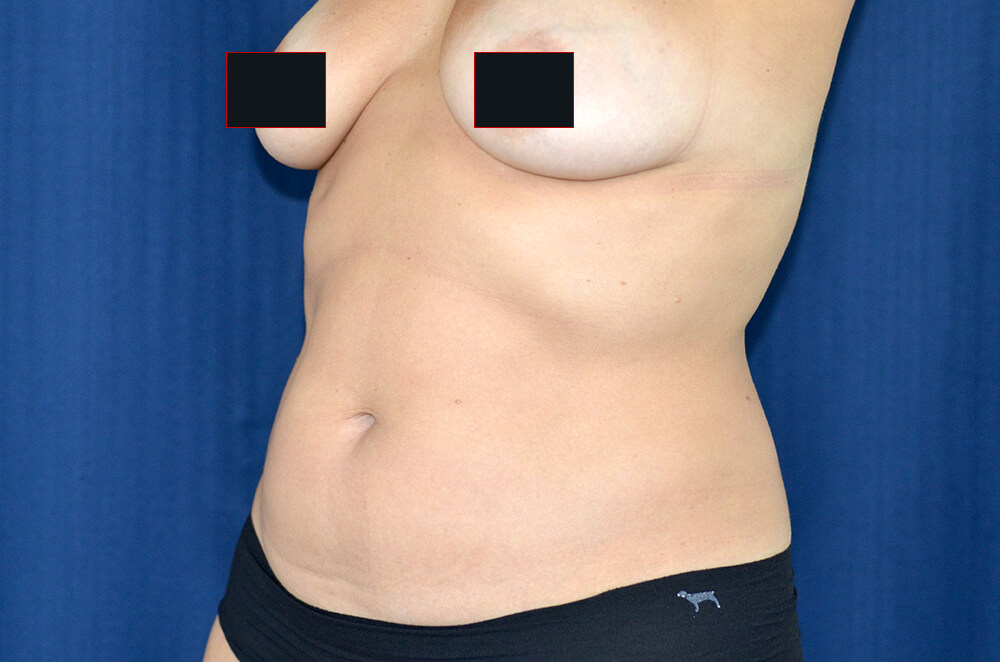 Liposuction