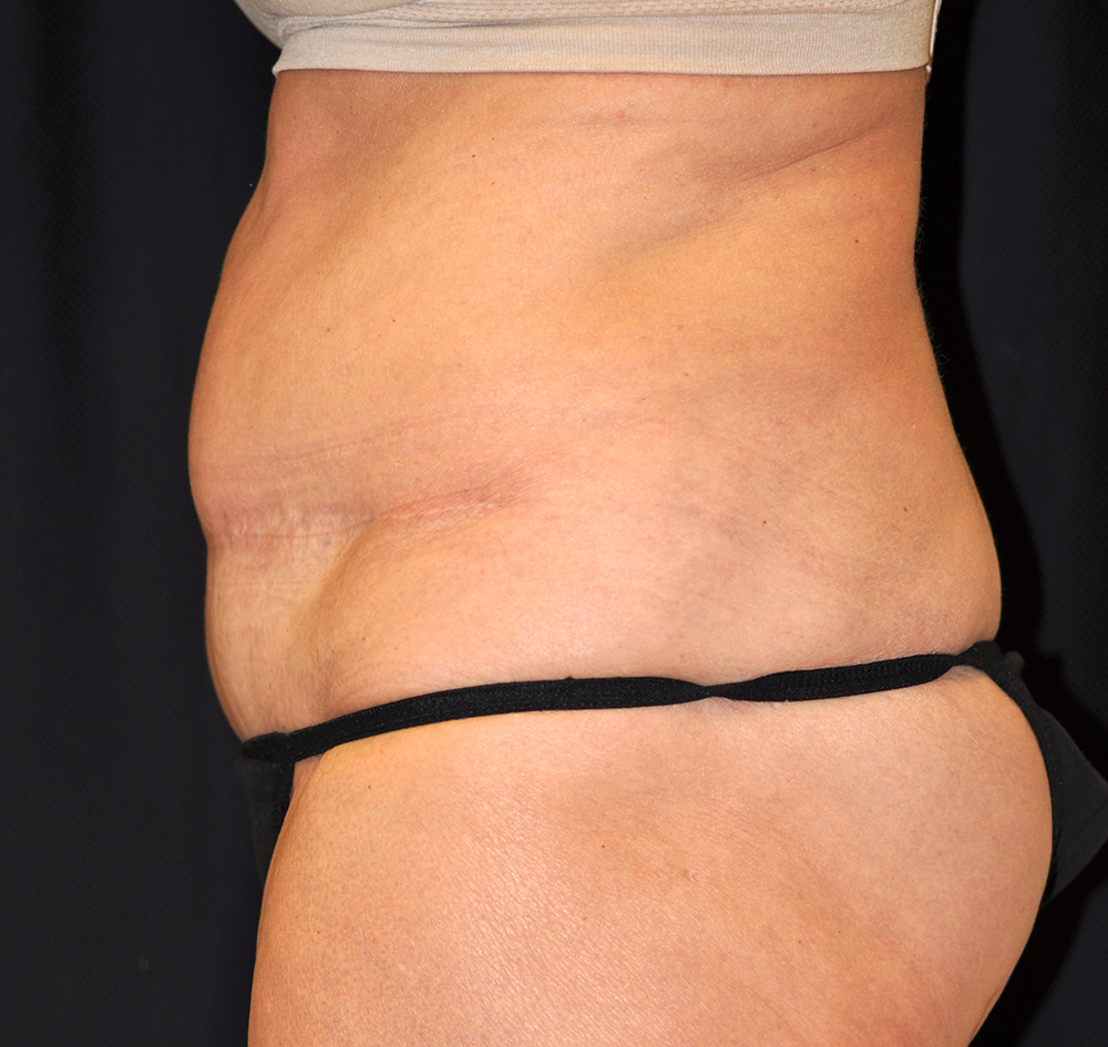 Tummy Tuck