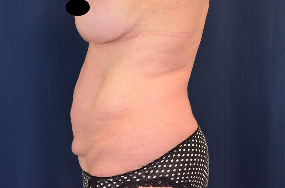 Tummy Tuck