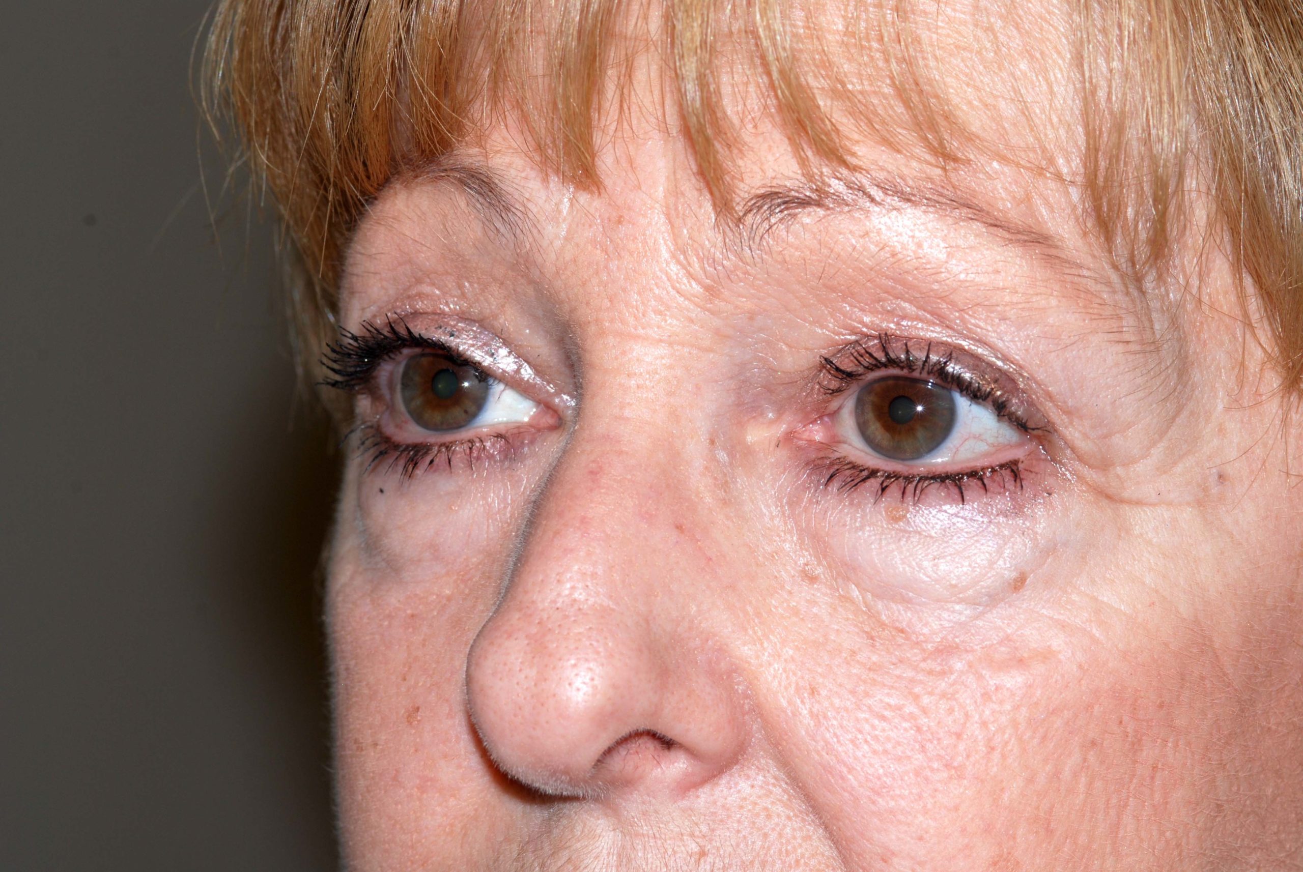 Eyelid Lift / Brow Lift