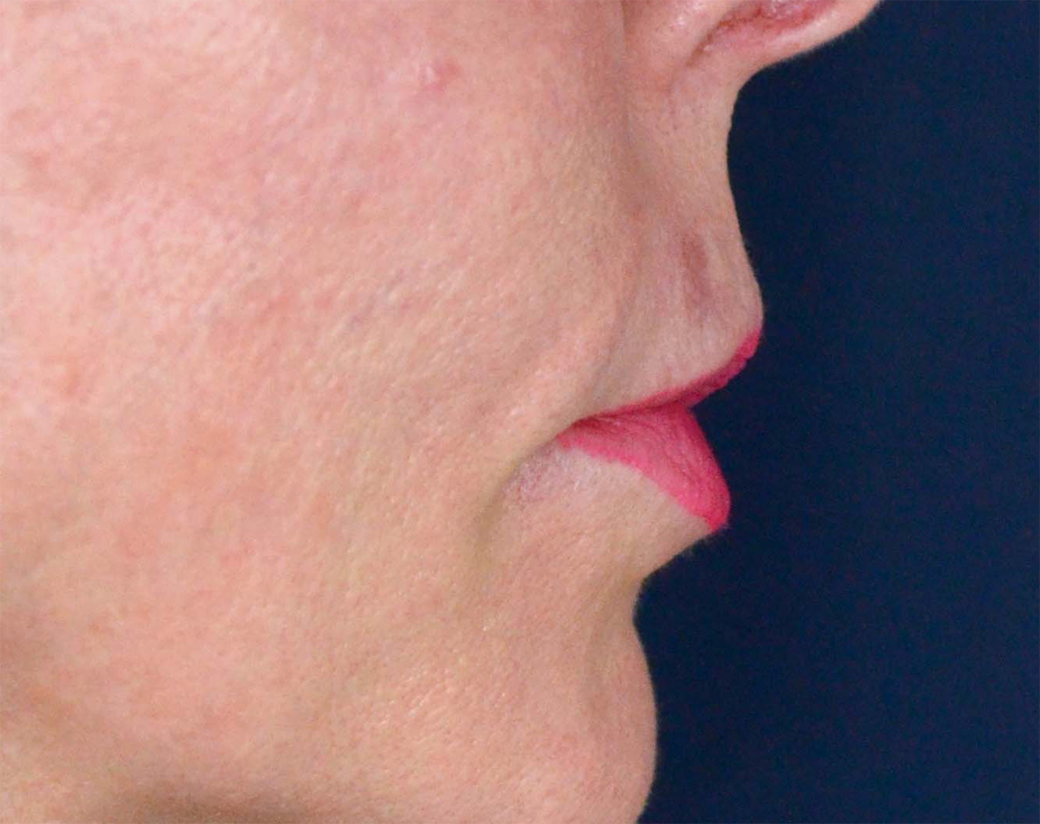 Lip Augmentation / Lip Lift