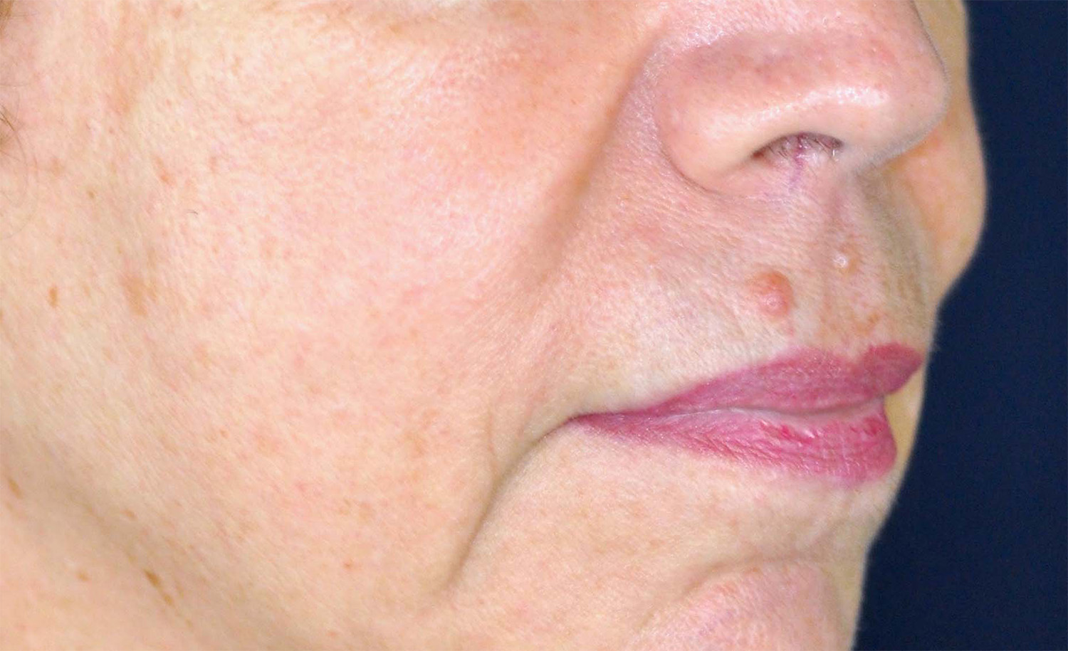 Lip Augmentation / Lip Lift