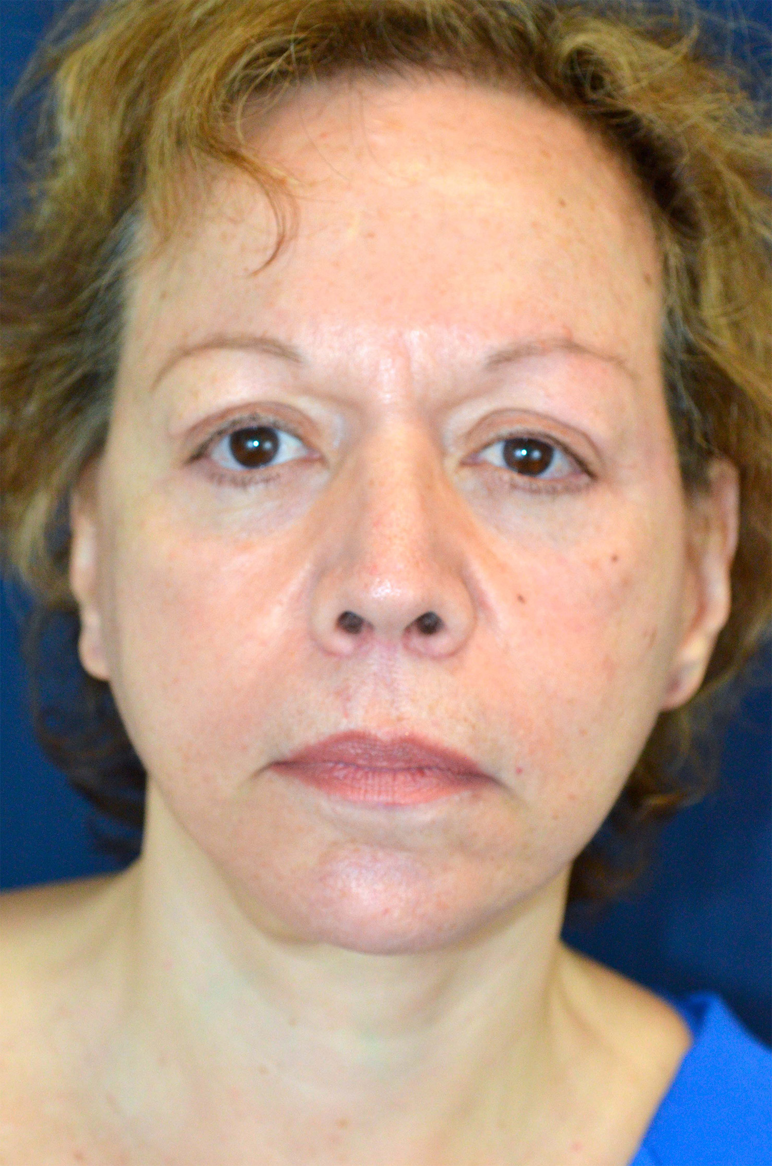 Facelift / Neck Lift