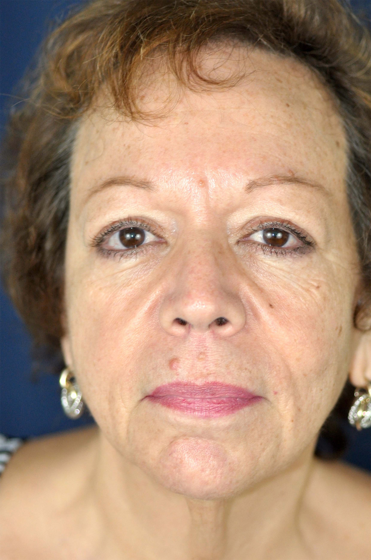Facelift / Neck Lift