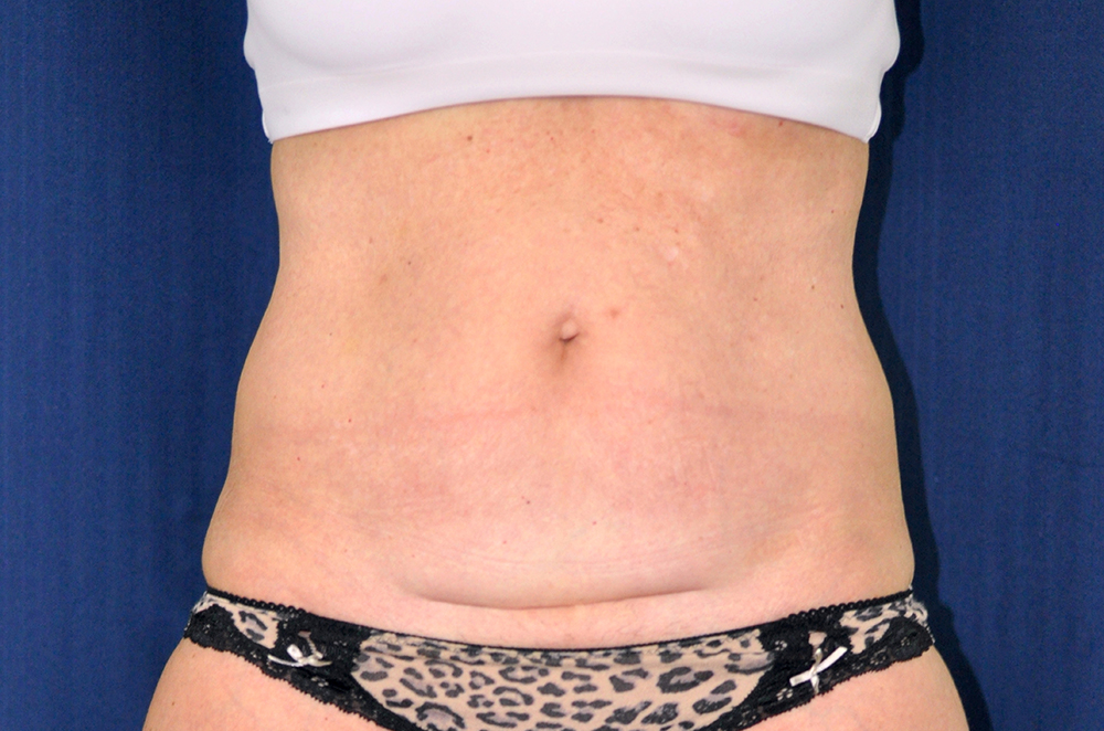 Tummy Tuck