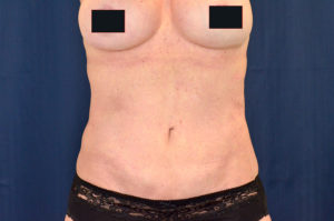 Le Spa Plastic Surgery Before and After Photos