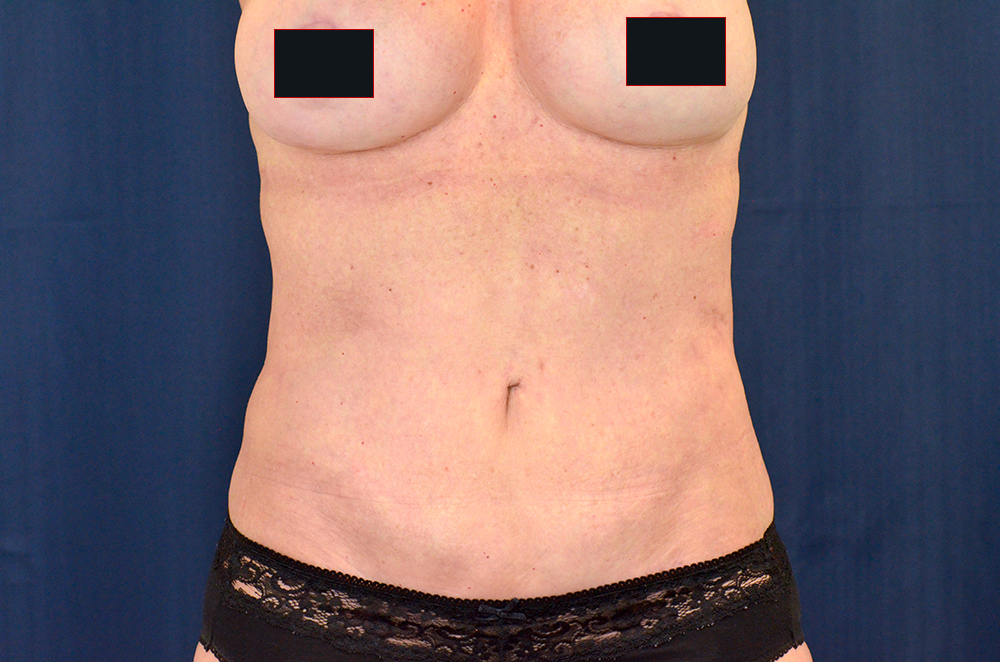 Tummy Tuck