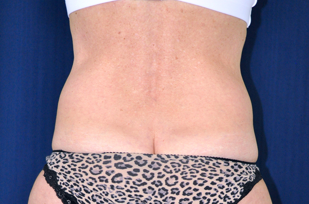 Tummy Tuck