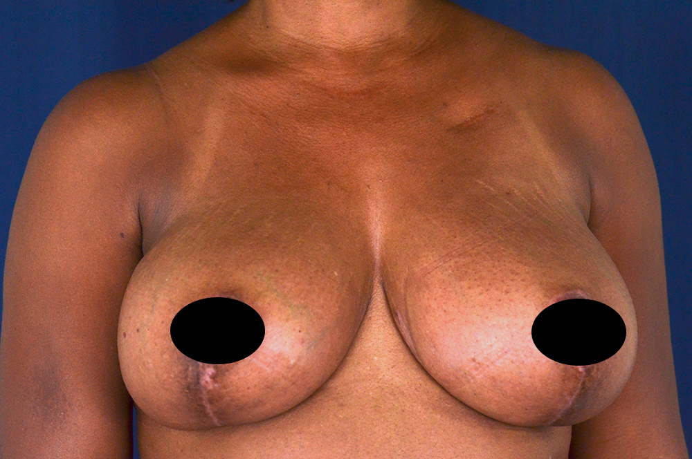 Breast Lift Reduction