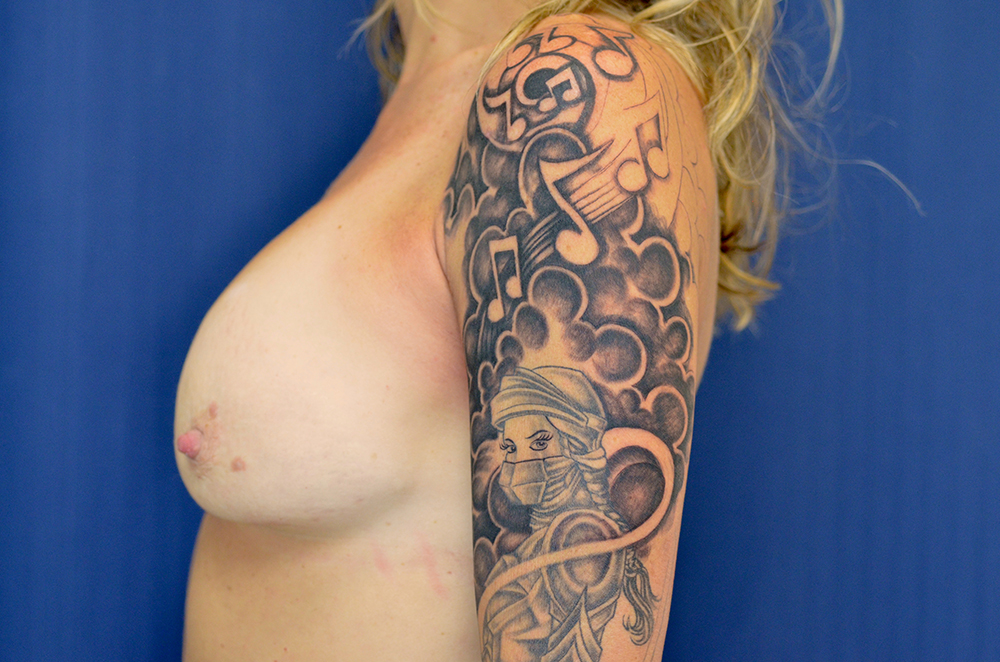 Breast Implant Revision