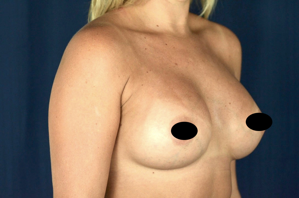 Breast Augmentation