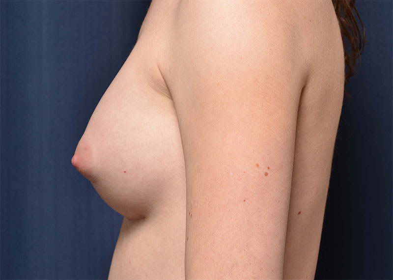 Transition Top Surgery