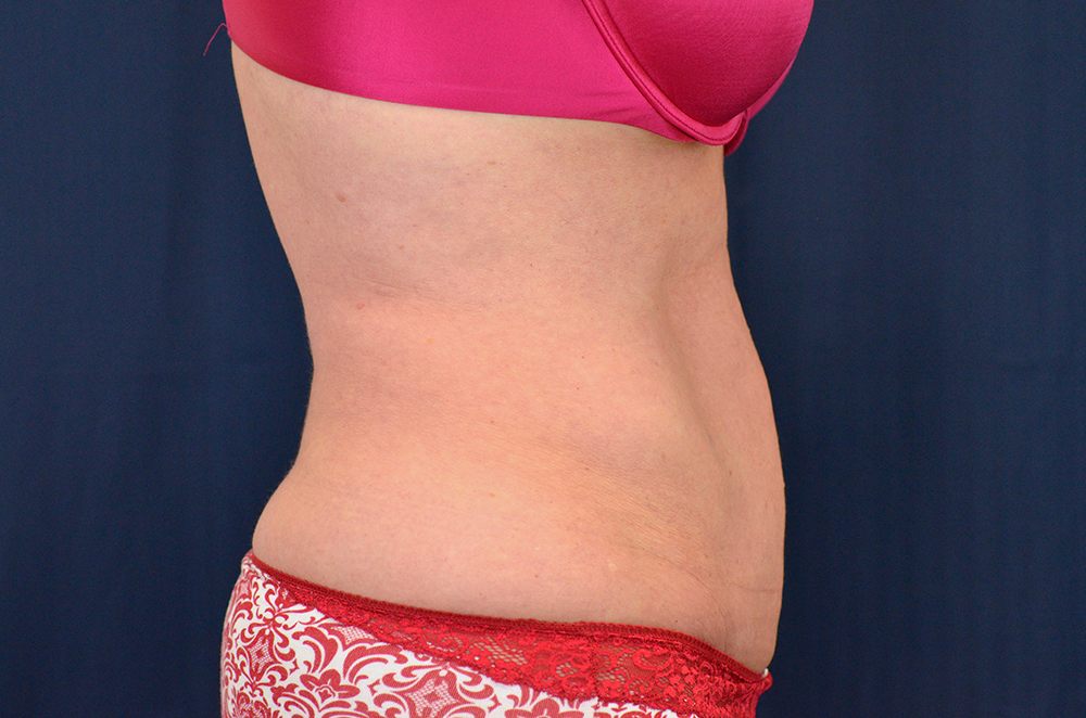 Tummy Tuck