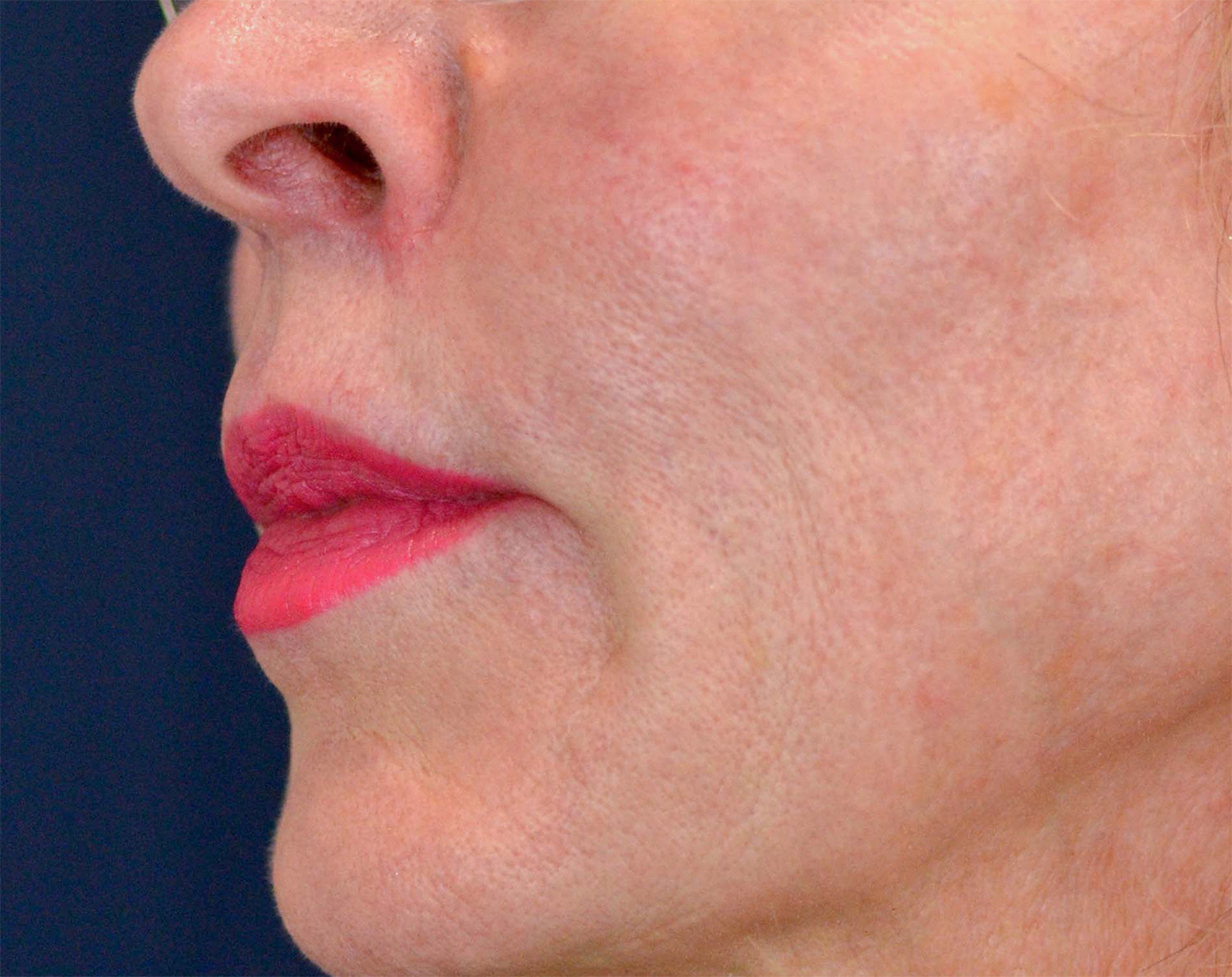 Lip Augmentation / Lip Lift