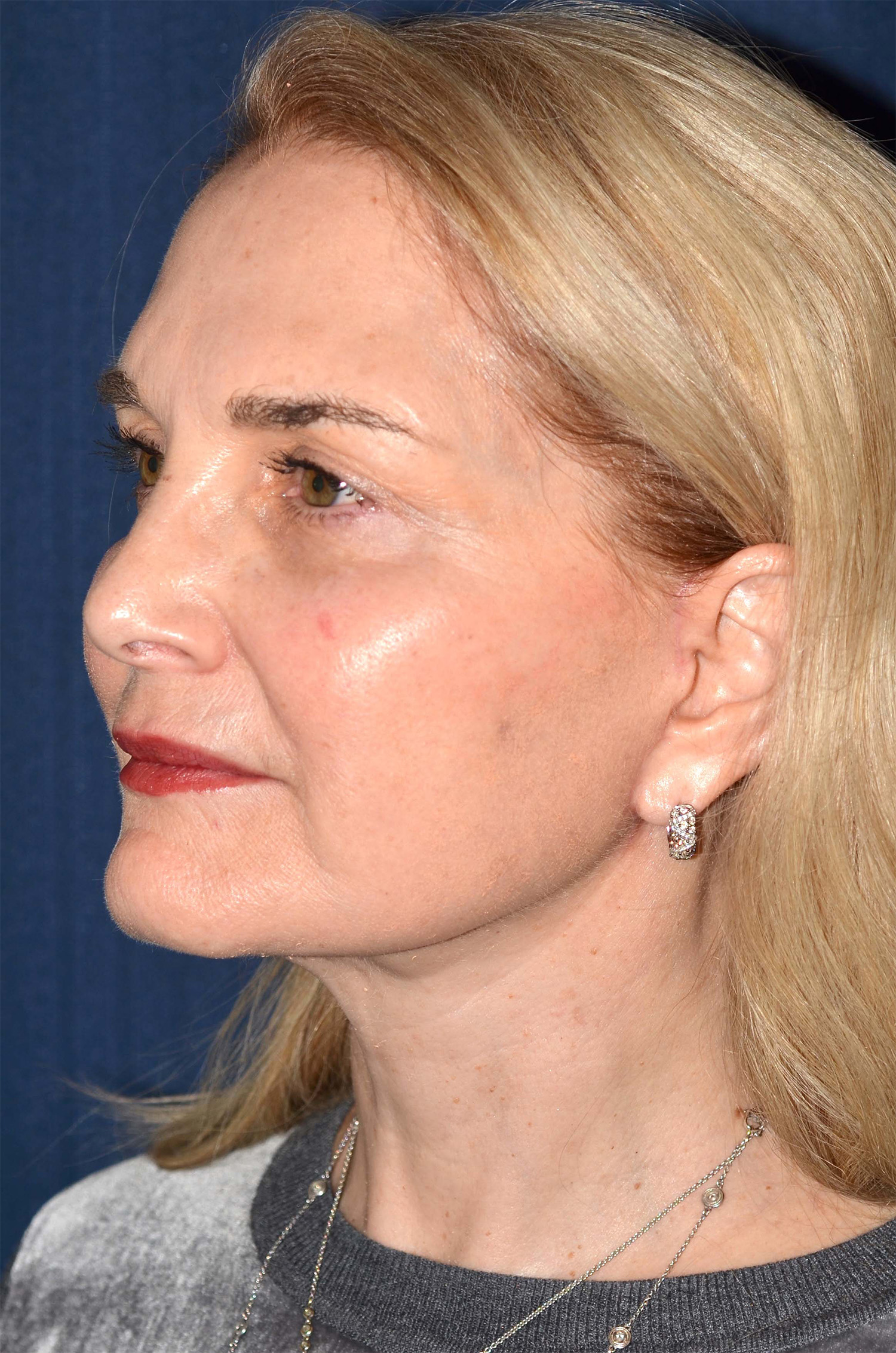 Facelift / Neck Lift