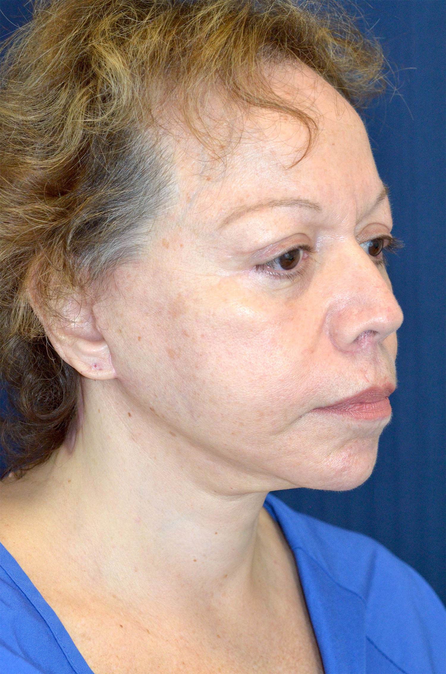 Facelift / Neck Lift