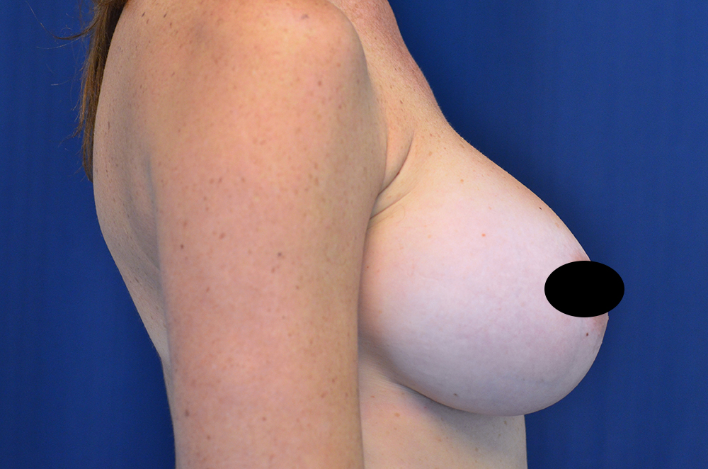 Breast Implant Revision