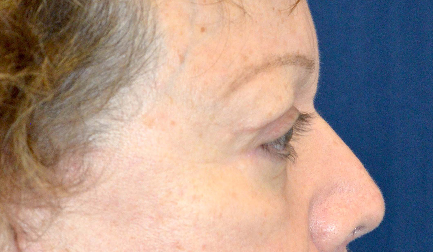 Eyelid Lift / Brow Lift