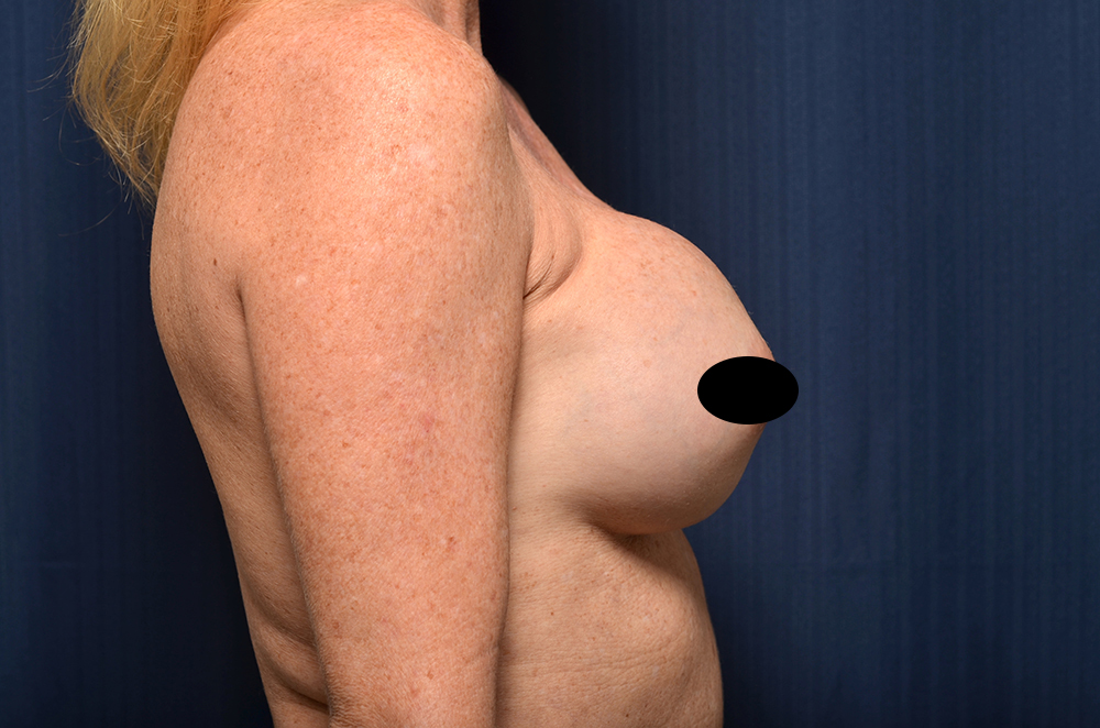 Breast Implant Revision